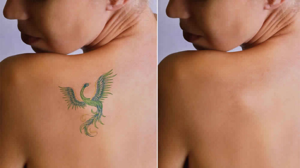 Laser Tattoo Removal Cardiff