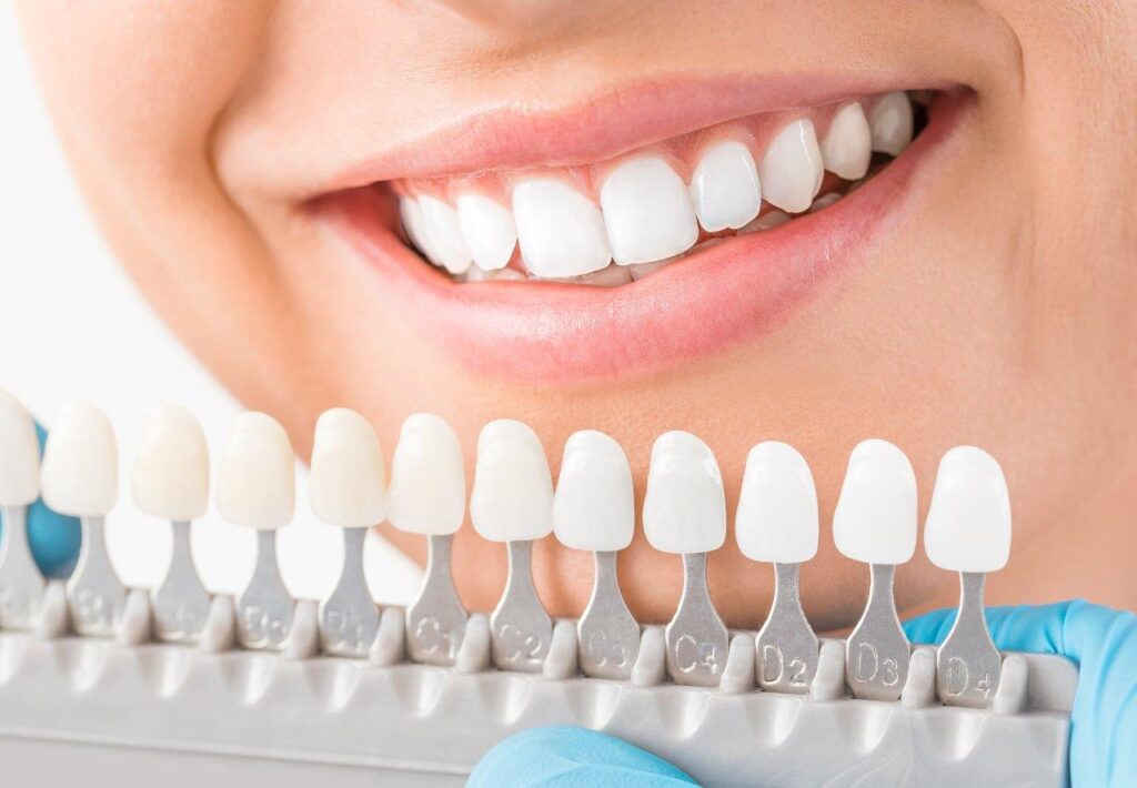Veneers in Palmdale